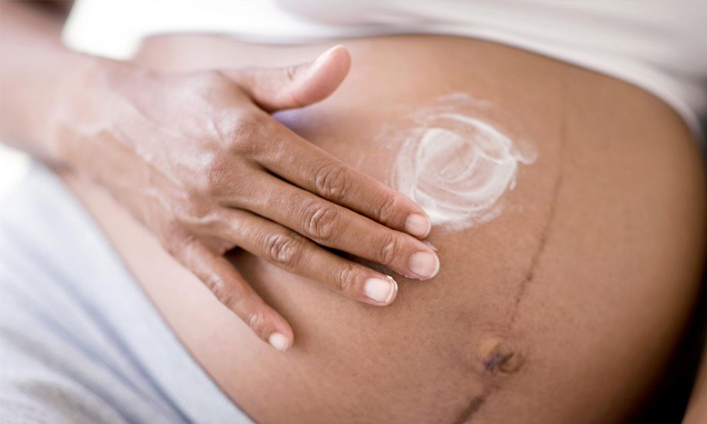 10 Best Creams & Oils to Prevent Stretch Marks 2026 10 Best Creams & Oils to Prevent Stretch Marks 2026